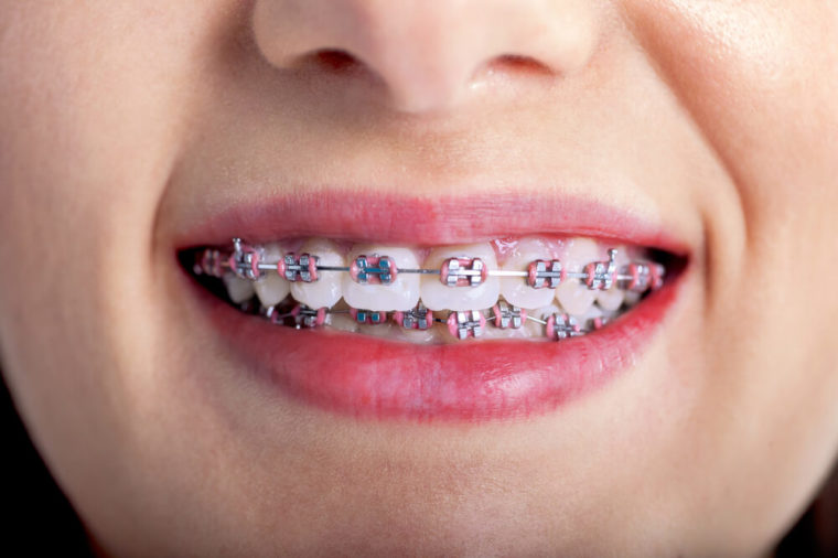 Taking Care Of Child’s Braces